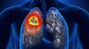 Akciğer kanseri türleri